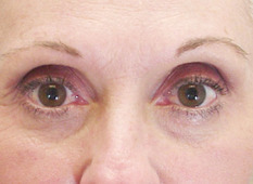 Eyelid lift (blepharoplasty), post-op