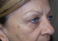 Upper eyelid lift (blepharoplasty), post-op